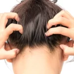 How to get rid of Dandruff in Winters?